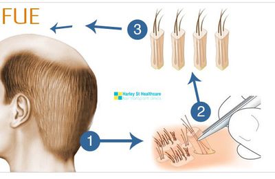 Book FUE Hair Transplant London For Lasting Solutions