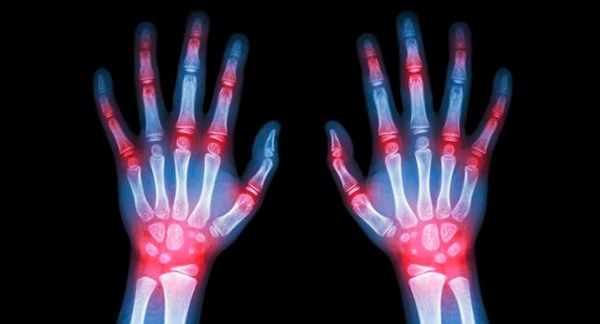 Fibromialgia o Artritis Reumatoide ¿que tengo?