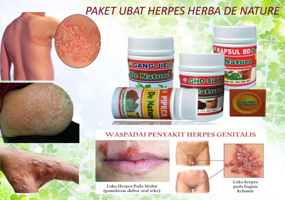 HERPES | Tips perubatan kudis herpes dengan ramuan tradisional tanpa kesan sampingan