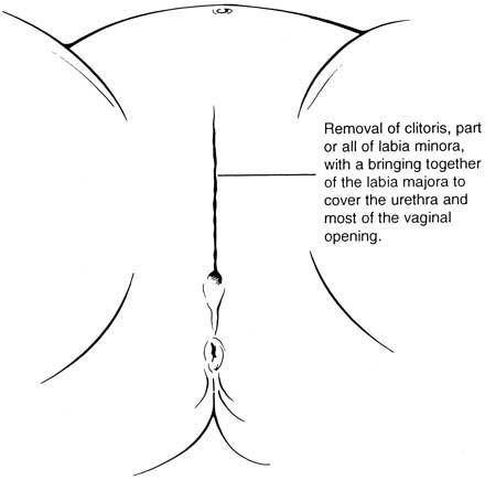 Type I  Excision du prépuce, avec ou sans excision partielle ou totale du clitoris / Type 2 - l'excision: ablation partielle ou totale du clitoris et des petites lèvres (replis internes de la vulve), avec ou sans excision des grandes lèvres (replis cutanés externes de la vulve). / Type 3 - l'nfibulation: rétrécissement de l’orifice vaginal par recouvrement, réalisé en sectionnant et en repositionnant les petites lèvres, ou les grandes lèvres, parfois par suture, avec ou sans ablation du clitoris (clitoridectomie).