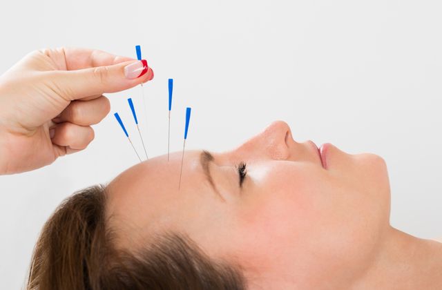 8 beneficios de la acupuntura para el sistema nervioso