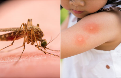 Bí quyết trị vết sẹo thâm muỗi đốt cho bé bằng 5 phương pháp cực kì đơn giản