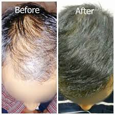 Find Out the Art of Medical Treatments of Hair Loss
