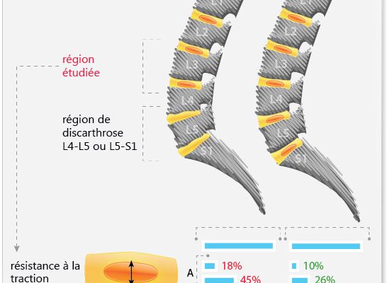 Arthrose lombaire evolution