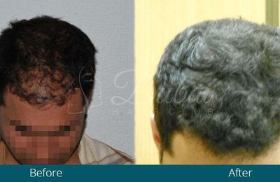 FUE Hair Transplants For Hair Restoration Treatment