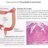 SEMIOLOGIE INTESTINALE. La maladie de CROHN