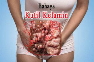  Obat Kutil Kelamin Alami 2 Oles Rotok Resep Dokter