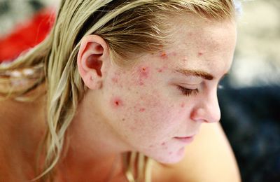 Quels aliments provoquent des poussées d'acné ?