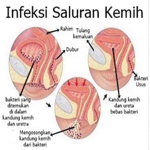 Kapsul Obat Kencing Sakit Ampuh Di Apotik Terdekat