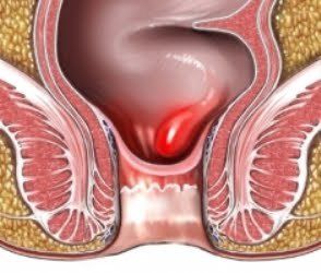 Cara Menghilangkan Benjolan Akibat Wasir Dengan Cepat