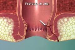 Tips Untuk Mengobati Penyakit Fistula Ani Tanpa Operasi