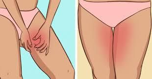 8 Astuces contre les jambes qui frottent en été 