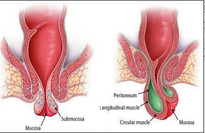 Locating Pain relief With Hemorrhoid Solutions