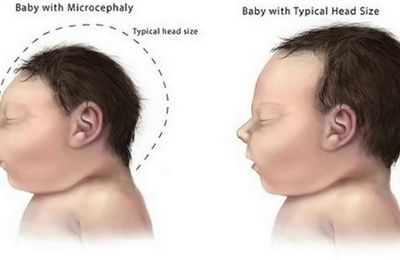 Mách bạn những cách nhận biết bệnh virus zika sớm nhất