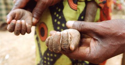 famine, travail forcé, guerre, déréglement du climat du aux activités humaines, chaque année, plus de 10 millions d'enfants décèdent avant leur cinquième anniversaire dans la plus totale indifférence. 
http://www.unicef.org/french/photoessa