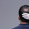 What are the top 5 things you might not know about hair transplants?