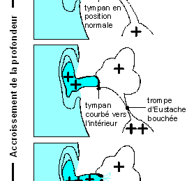 LES BAROTRAUMATISMES DE L'APNEE