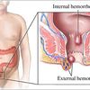 Your own personal Hemorrhoid Signs or symptoms Can Fade away With Suitable Treatments along with Cures