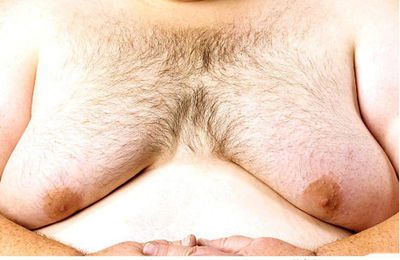 What is gynecomastia? 