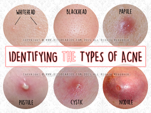 Blackheads and cysts