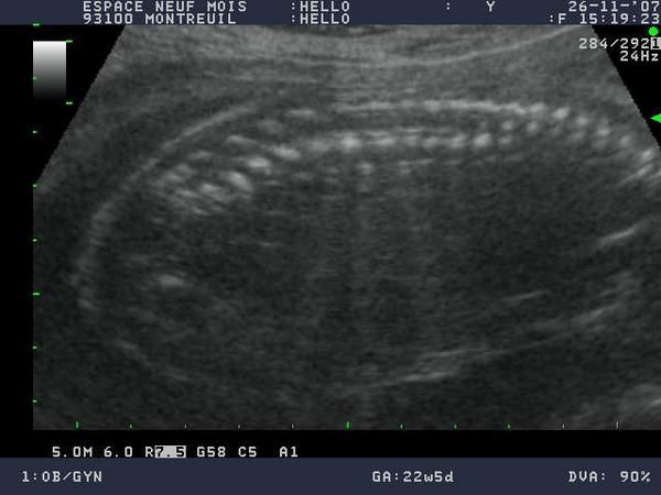 le 26 novembre 2007, à 23SA soit 21 semaines de grossesse