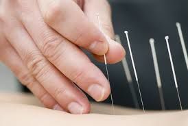 Acupuncture et stress